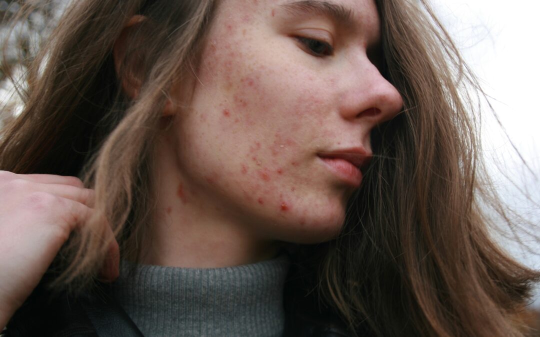 PCOS Acne: What Actually Clears Hormonal Breakouts at the Root